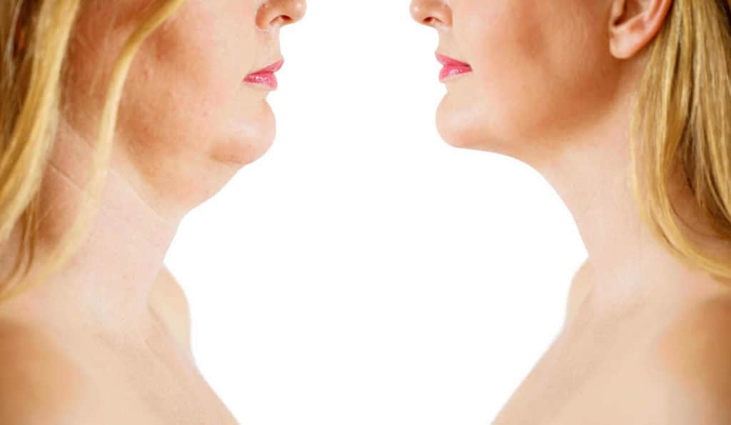 Double Chin treatment Brownhills before and after results