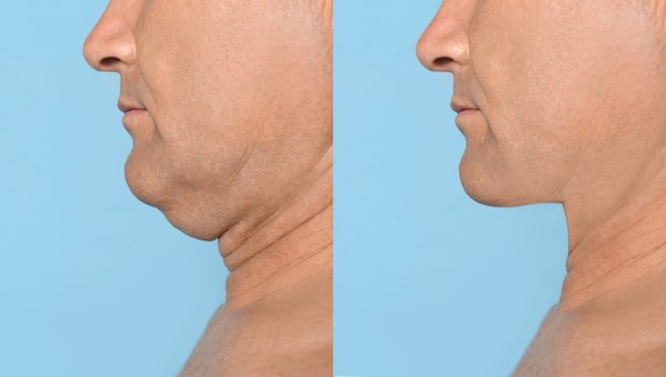 Which Non-Surgical Treatments Work Best for Jowls and Loose Skin Brownhills?