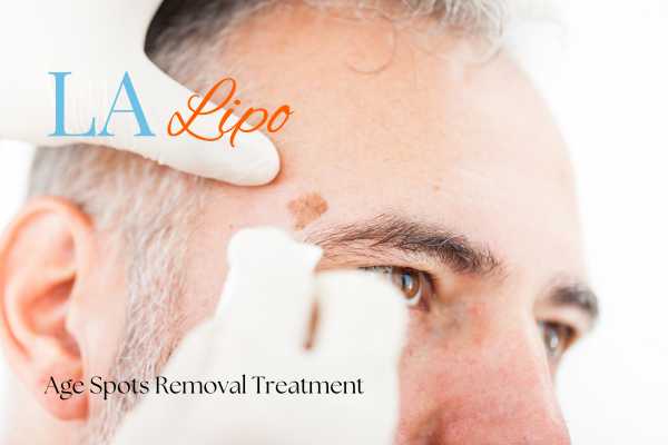 What Are the Most Effective Treatments for Age Spots Brownhills?