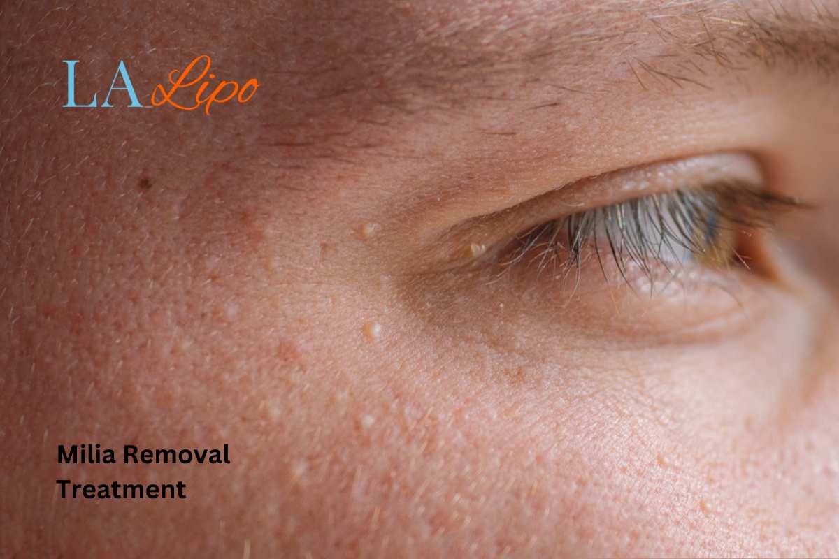 Cryopen Milia Removal: Is It the Easiest and Safest Option Brownhills?