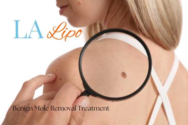 Why getting moles removed Brownhills can boost your confidence!