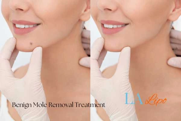 woman's before and after mole removal Brownhills results