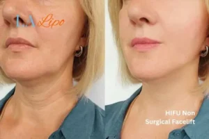hi-fu for wrinkles Brownhills before and after results