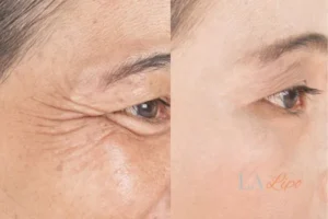 Before and after results of woman - HI-fu wrinkles reduction treatment Brownhills