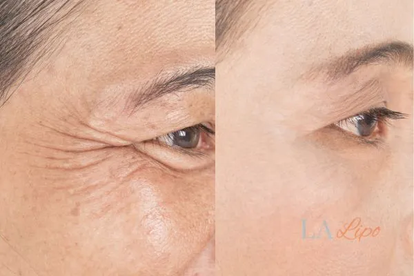 Before and after results of woman - HI-fu wrinkles reduction treatment Brownhills