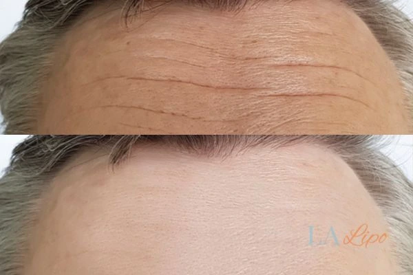 results of HIFU Brownhills on mans forehead to help reduce lines and wrinkles