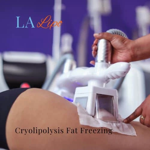 fat freezing - Cryolipolysis Brownhills