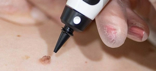 skin tag removal using cryopen Brownhills