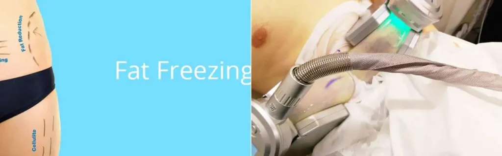 Fat freezing Brownhills on multiple areas of the body