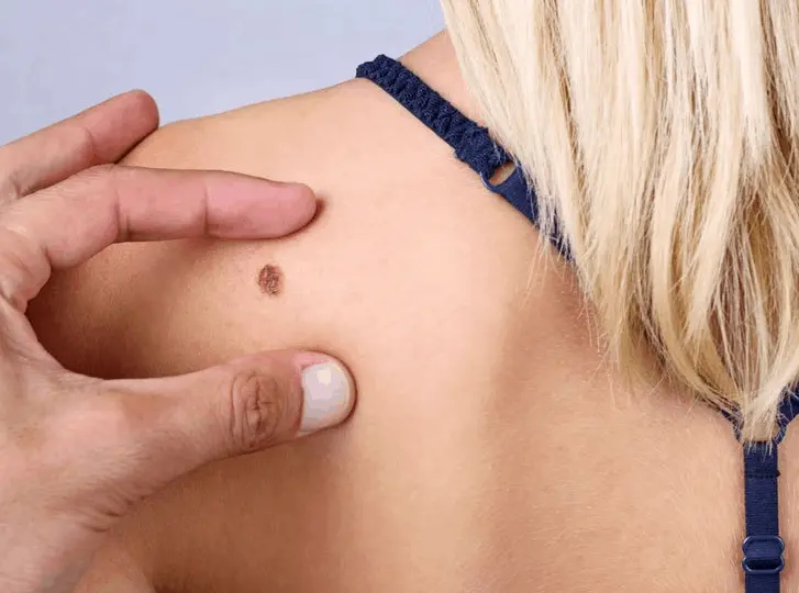 woman having mole removal Brownhills consultation before treatment.