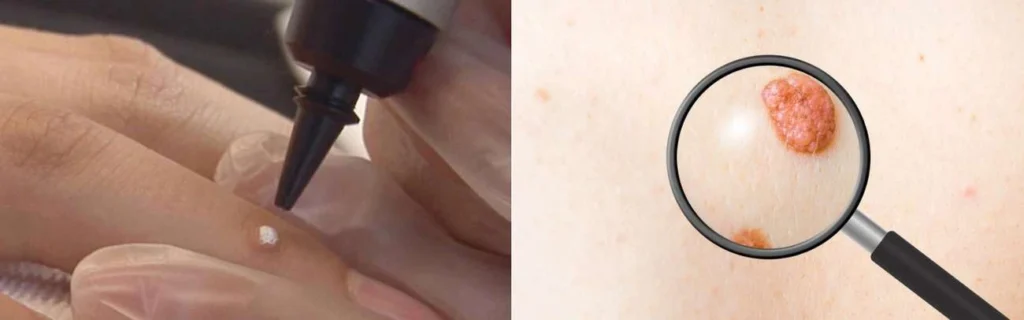Person getting moles removed with cryopen Brownhills