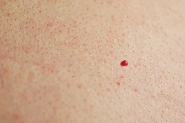 close up of a cherry angioma Brownhills