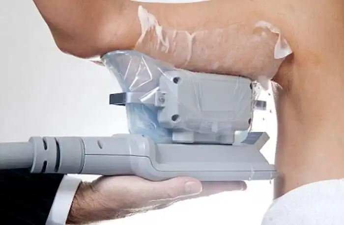 Picture of fat freezing Brownhills on the upper arms.