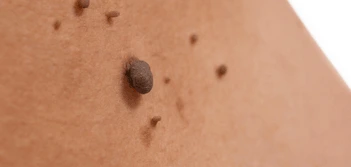 image of a skin tag Brownhills
