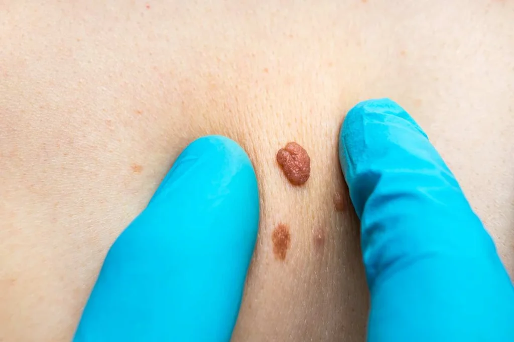 Consultant examining a skin tag Brownhills