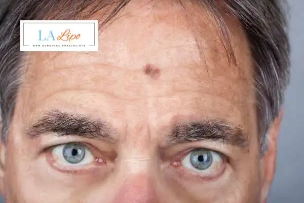 Solar Lentigo Removal Brownhills image of man with mark on his forehead