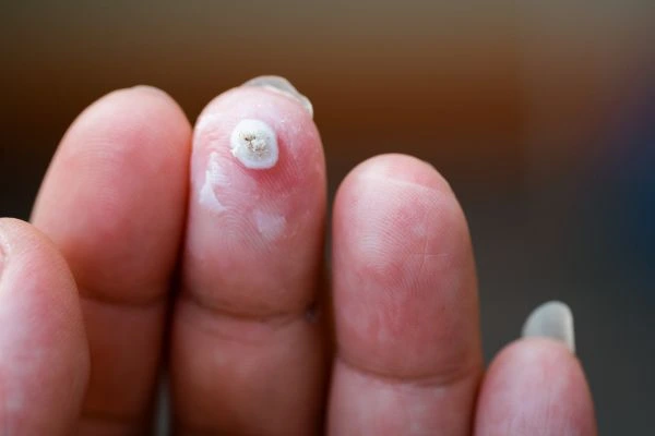 wart on person finger - cryotherapy to treat from LA LIPO Brownhills