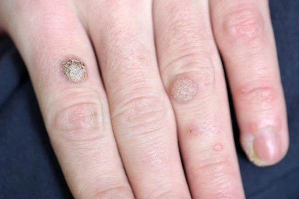 photo of warts on person hand - see wart removal Brownhills from LA LIPO