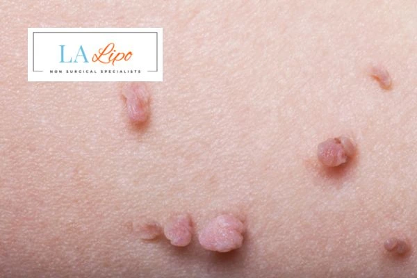 Does cryopen skin tag removal Brownhills hurt? Find out now call our team today!