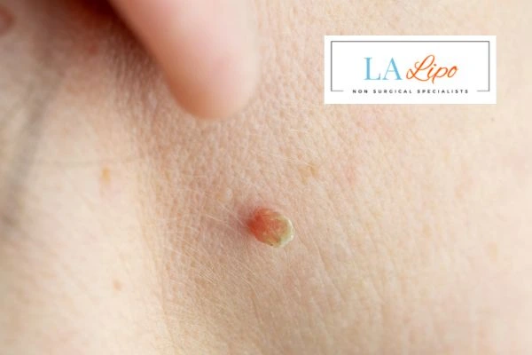 Book skin tag removal Brownhills today speak to our team now!