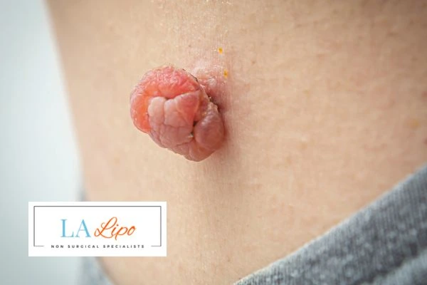 Interested in skin tag removal Brownhills? Concerned about the pain? Find out more today!