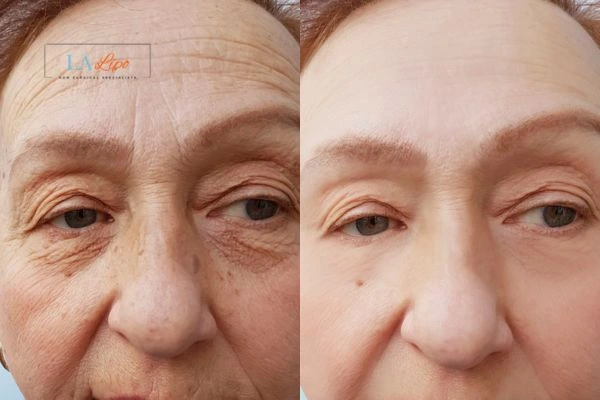 The powerful benefits of Morpheus8 Treatment Brownhills - Call Our team today!
