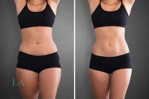 before and after results of non-surgical treatment to help a woman's body image and mental health Brownhills