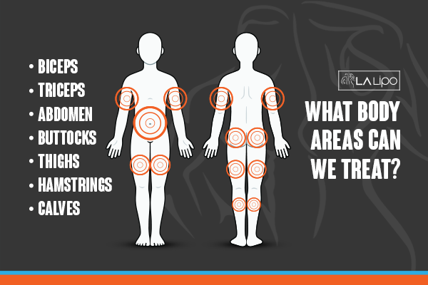 Diagram to show areas you can have LA-EMS Body Sculpting Treatment Brownhills