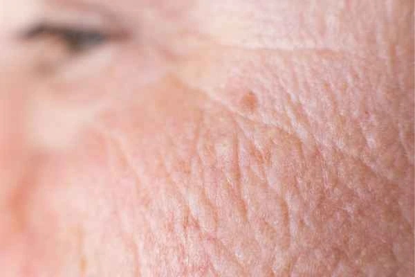 close up picture of a woman's face showing an age spot Brownhills