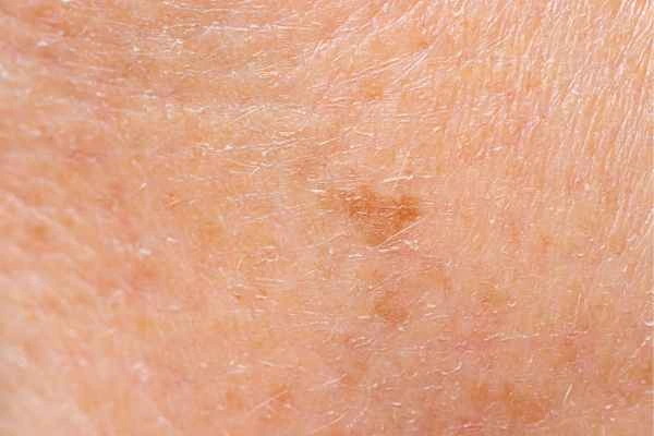 close up picture of age spots Brownhills