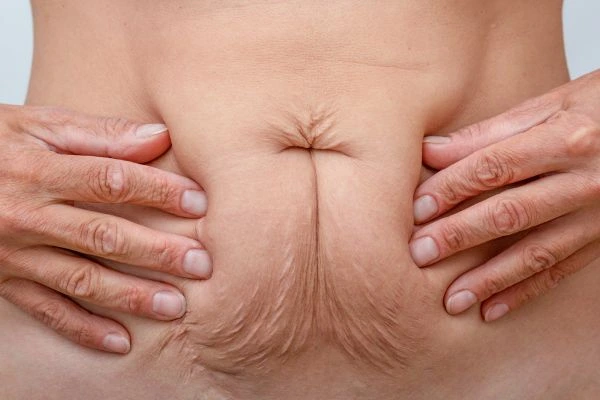 Image of a woman's stomach with loose skin - example of skin tightening Brownhills options